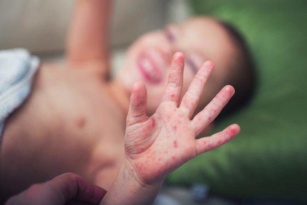 4 Things Parents Need to Know About Hand-Foot-and-Mouth Disease