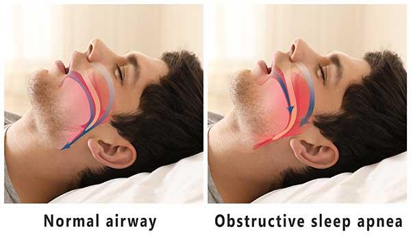 Understanding Sleep-Wake Disorders