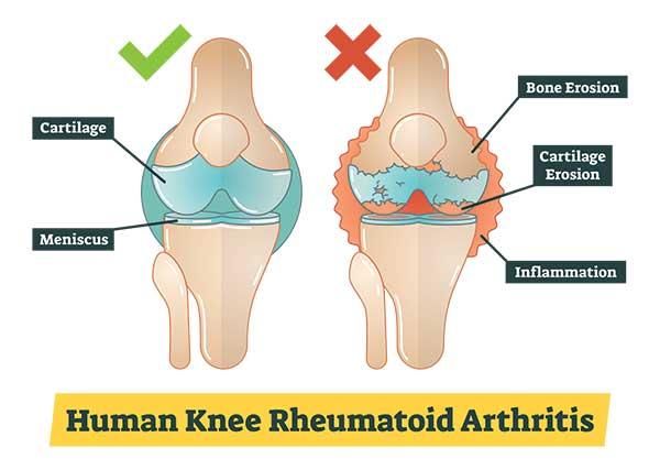 Signs of Arthritis for Different Parts of the Body