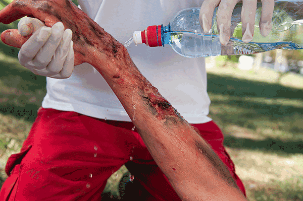Causes, Types of Common Burn Injuries
