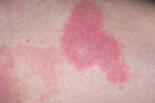 4 Possible Causes of Hives That Will Surprise You