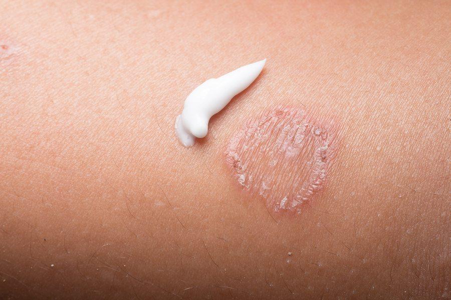 4 Most Common Fungal Infections and How to Treat Them