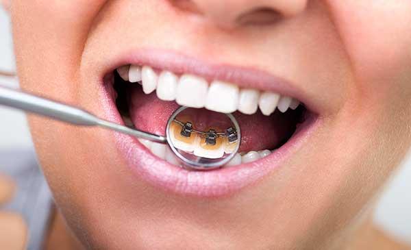 How Lingual Braces Are an Effective