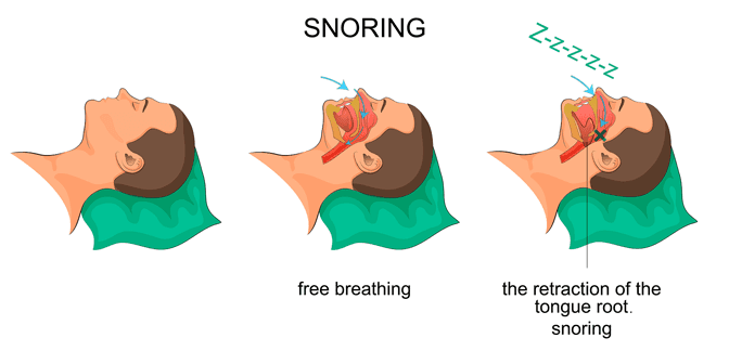 Does Your Partner Snore?