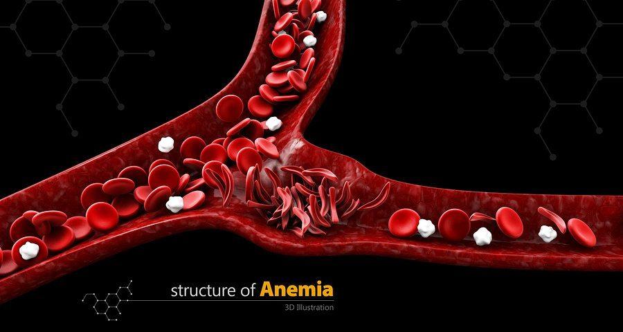 Strange Symptoms of Iron-Deficiency Anemia