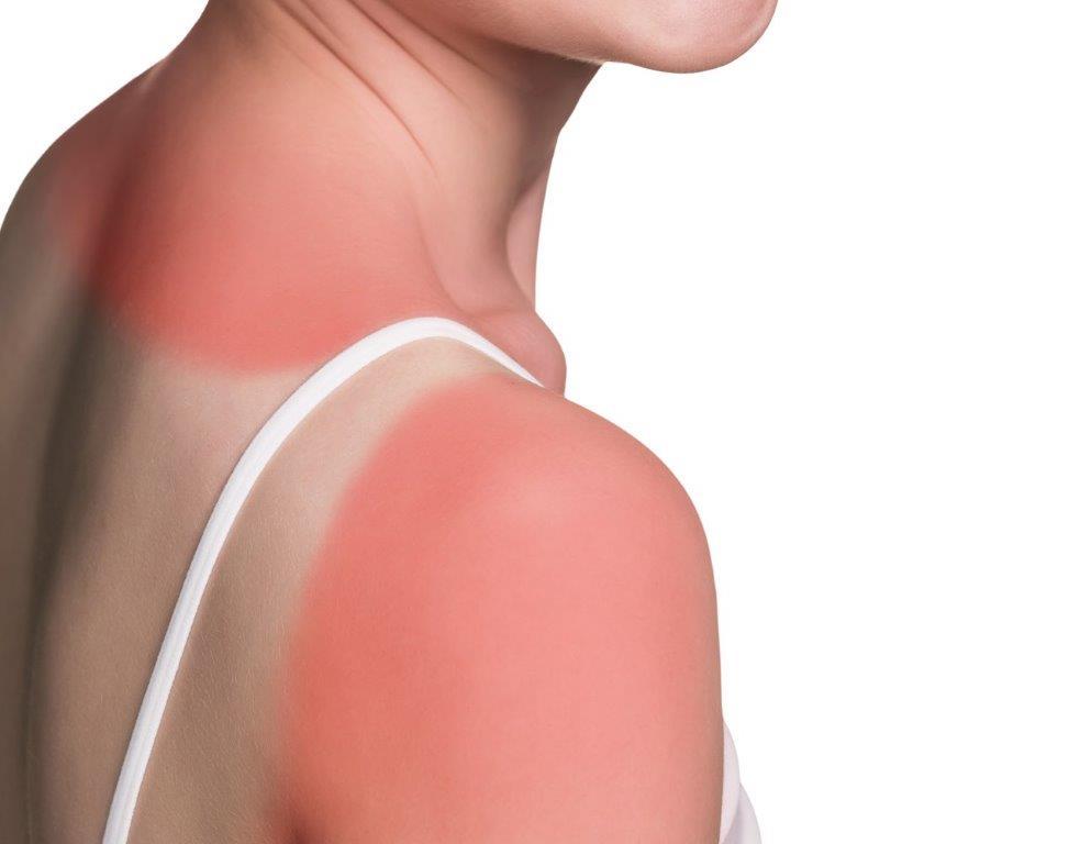 Sunburns: 6 Tips to Help Soothe the Burn