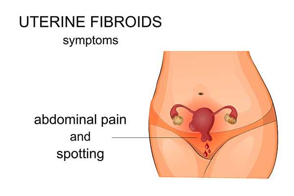 The Facts About Uterine Fibroids