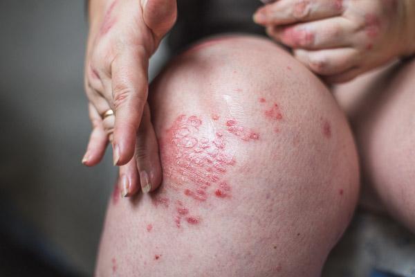 Common Allergens that Trigger Eczema Flares