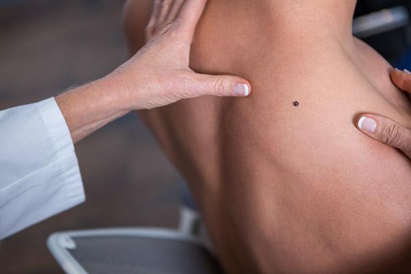 Mole or Melanoma? Know the Difference
