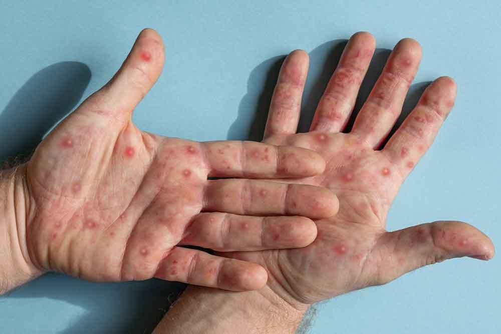 Monkeypox : Everything You Need to Know