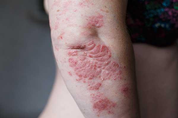 Psoriasis : Challenges, Causes, Symptoms, Diagnosis and Treatment