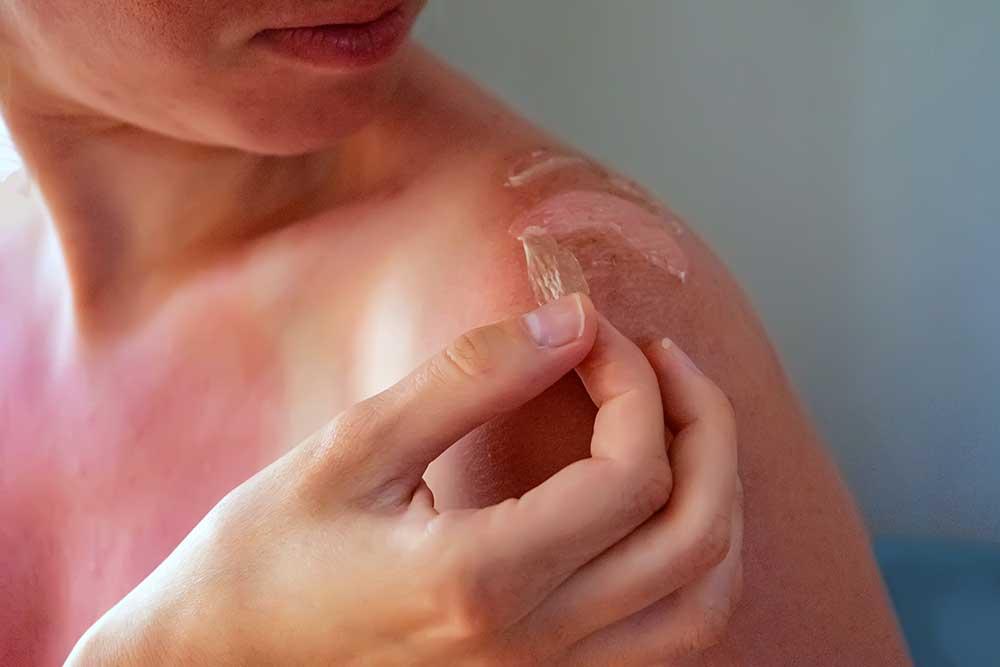 When Does Sunburn Become Serious?